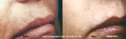 lip_augmentation1