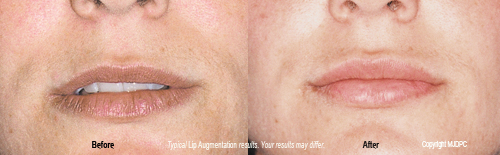 lip_augmentation2