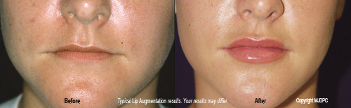 lip_augmentation3