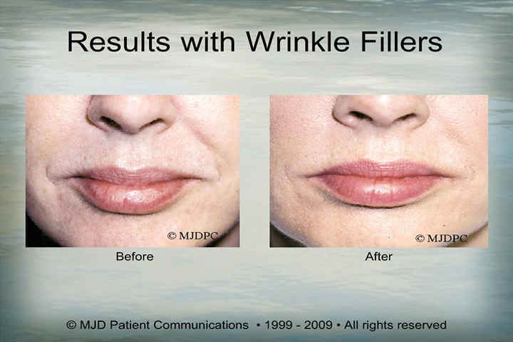 WrinkleFillers_p05