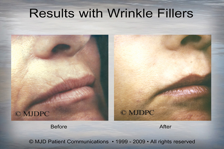 WrinkleFillers_p06