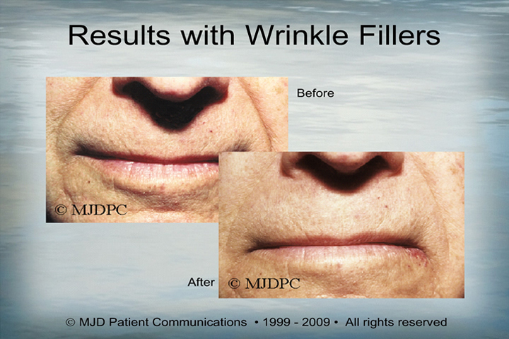 WrinkleFillers_p07