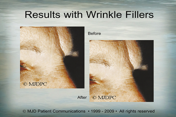 WrinkleFillers_p09