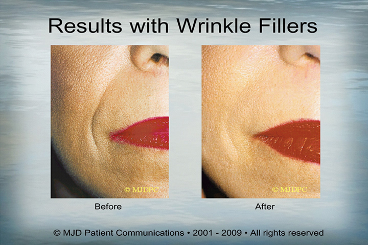 WrinkleFillers_p11