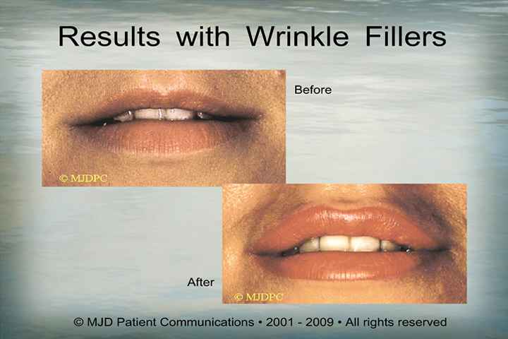 WrinkleFillers_p13